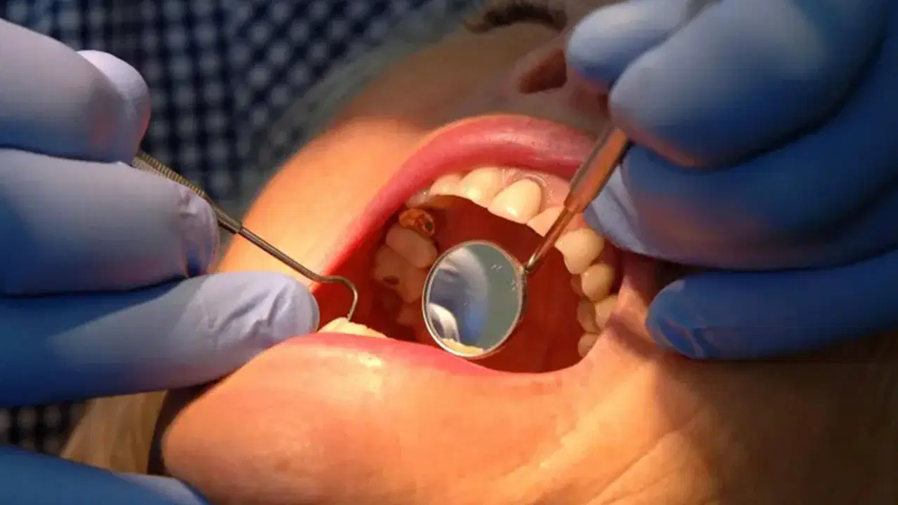 dis minesini onaran yeni jel curuklerin sonu mu geliyor dPZ47ksT.jpg