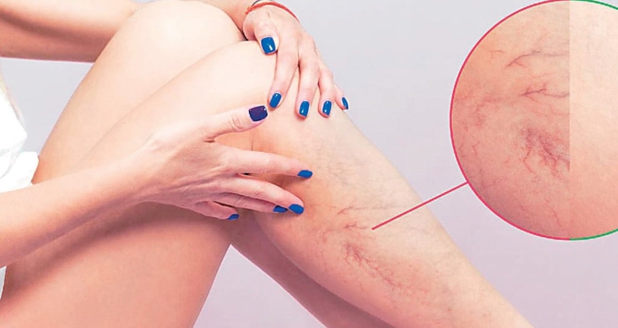 varis vucutta pihti riskini artirabilir vgmwsTvK.jpg